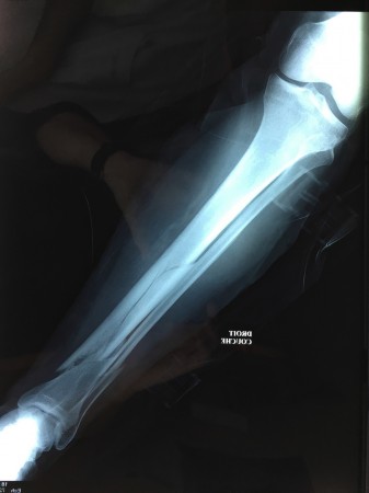 Long fracture